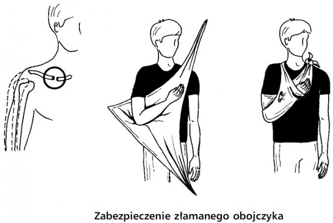 Zabezpieczenie złamanego obojczyka.