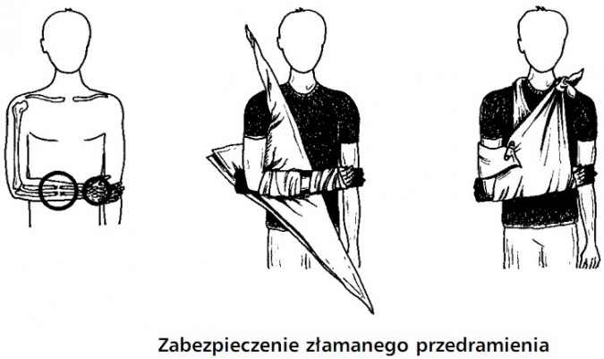 Zabezpieczenie złamanego przedramienia.