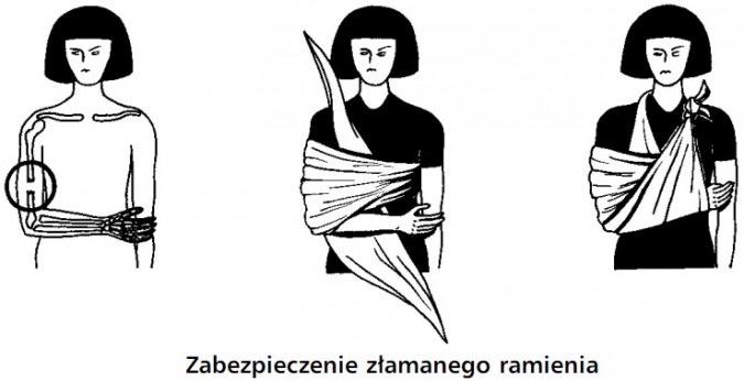 Zabezpieczenie złamanego ramienia.