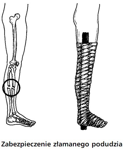 Zabezpieczenie złamanego podudzia.