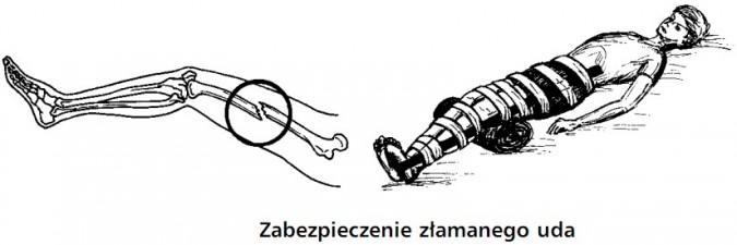 Zabezpieczenie złamanego uda.
