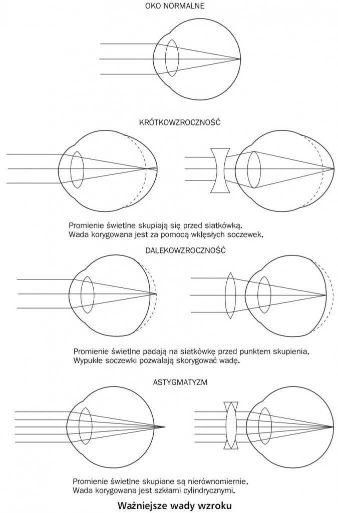 Ważniejsze wady wzroku. Oko normalne. Krótkowzroczność - promienie świetlne skupiają się przed siatkówką, wada korygowana jest za pomocą wklęsłych soczewek. Dalekowzroczność - promienie świetlne padają na siatkówkę przed punktem skupienia, wypukłe soczewki pozwalają skorygować wadę. Astygmatyzm - promienie świetlne skupiane są nierównomiernie, wada korygowana jest szkłami cylindrycznymi.
